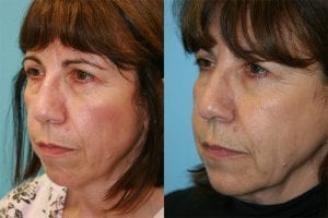 Before and After Image