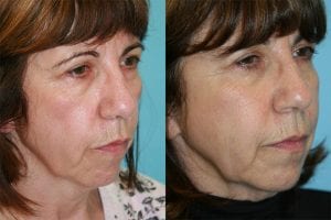 Before and After Image