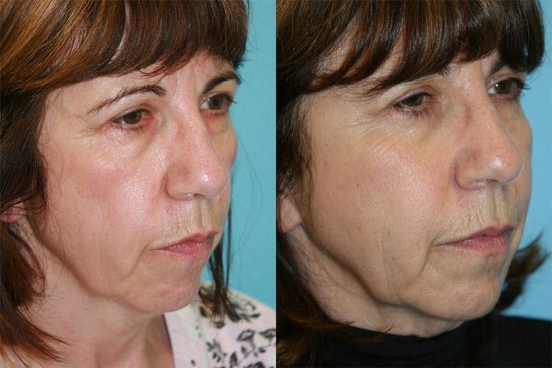 Before and After Image