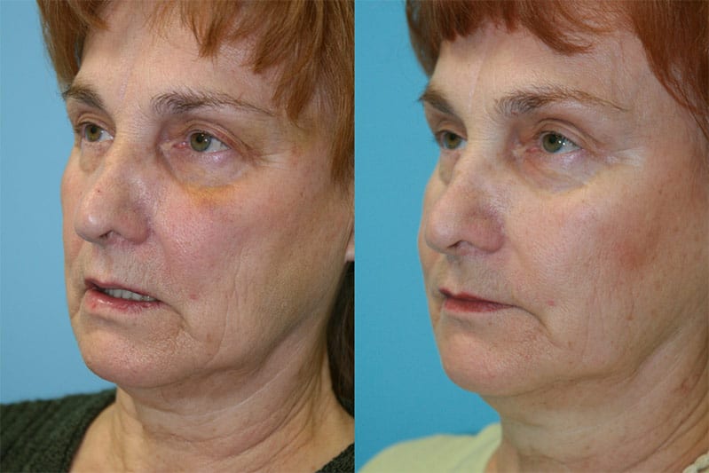 Before and After Image