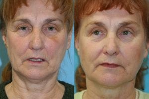 Before and After Image